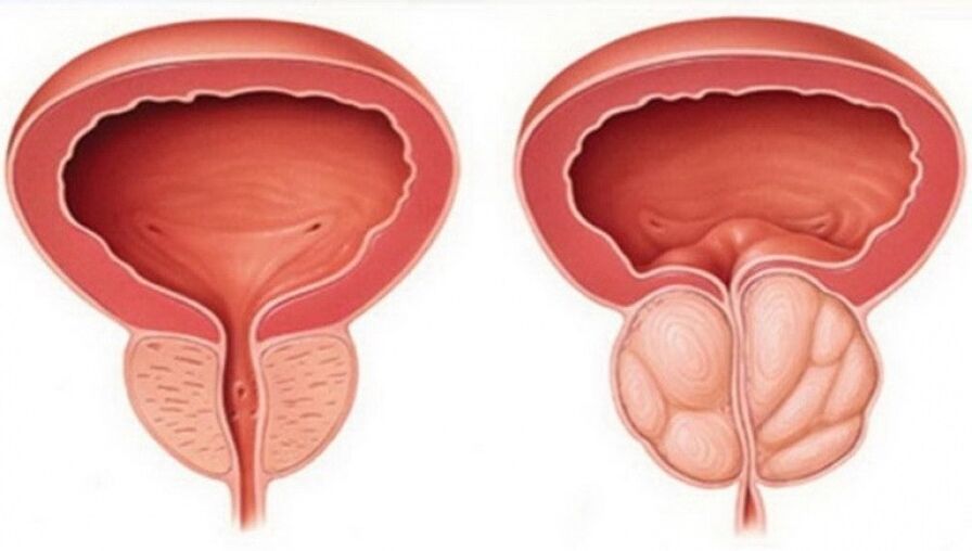 próstata sana e inflamada con prostatitis
