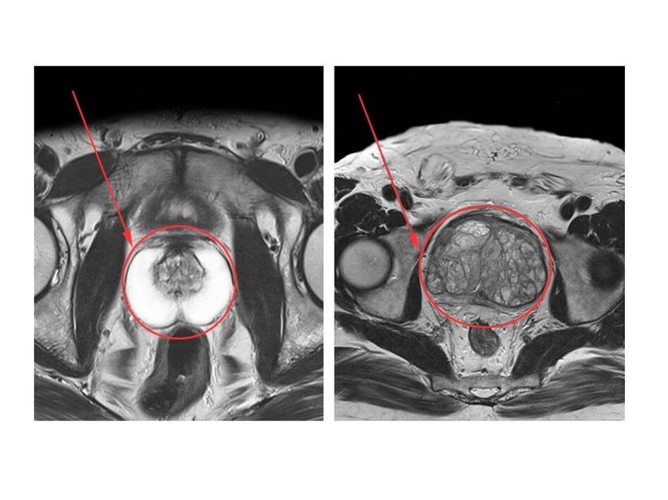 Comparación de una próstata sana (izquierda) e inflamada (derecha) en imágenes de resonancia magnética